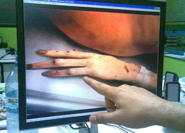 Monitor image showing a four-fingered hand with marks and discoloration